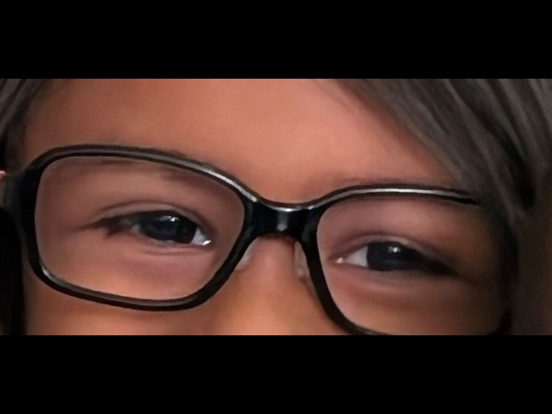 The same young girl wearing glasses, with both eyes looking straight ahead.