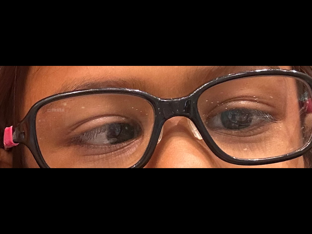 Young girl looking at the camera with glasses; one eye visibly turns inward toward her nose.